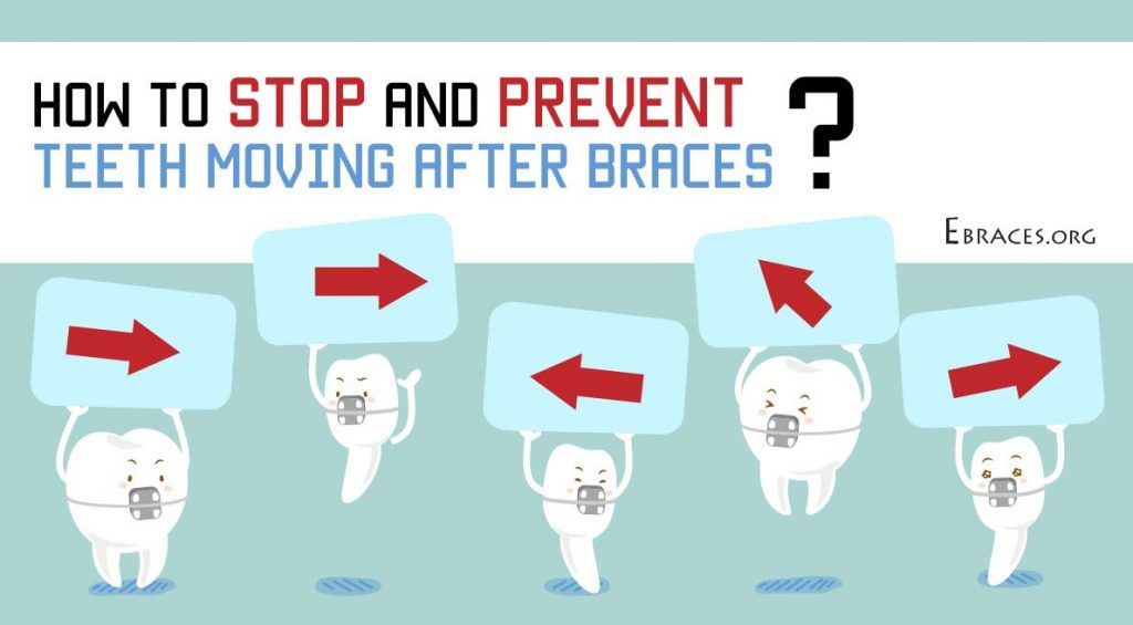 How to Stop and Prevent Teeth from Moving After Braces